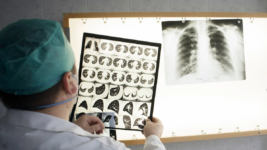 Könnun: Rúmlega helmingur óttast ekki útbreiðslu berklaveiki á Íslandi