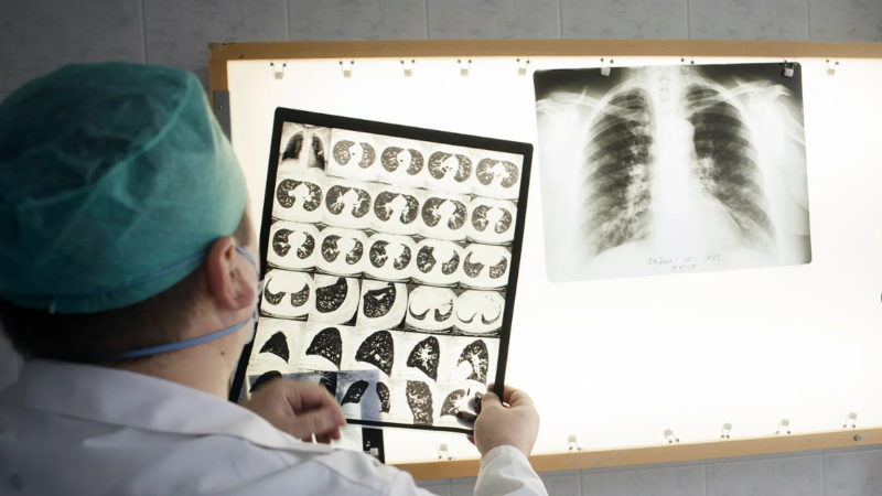 Könnun: Rúmlega helmingur óttast ekki útbreiðslu berklaveiki á Íslandi