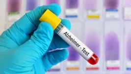 Blóðpróf gæti greint Alzheimer mörgum árum áður en einkenni koma fram